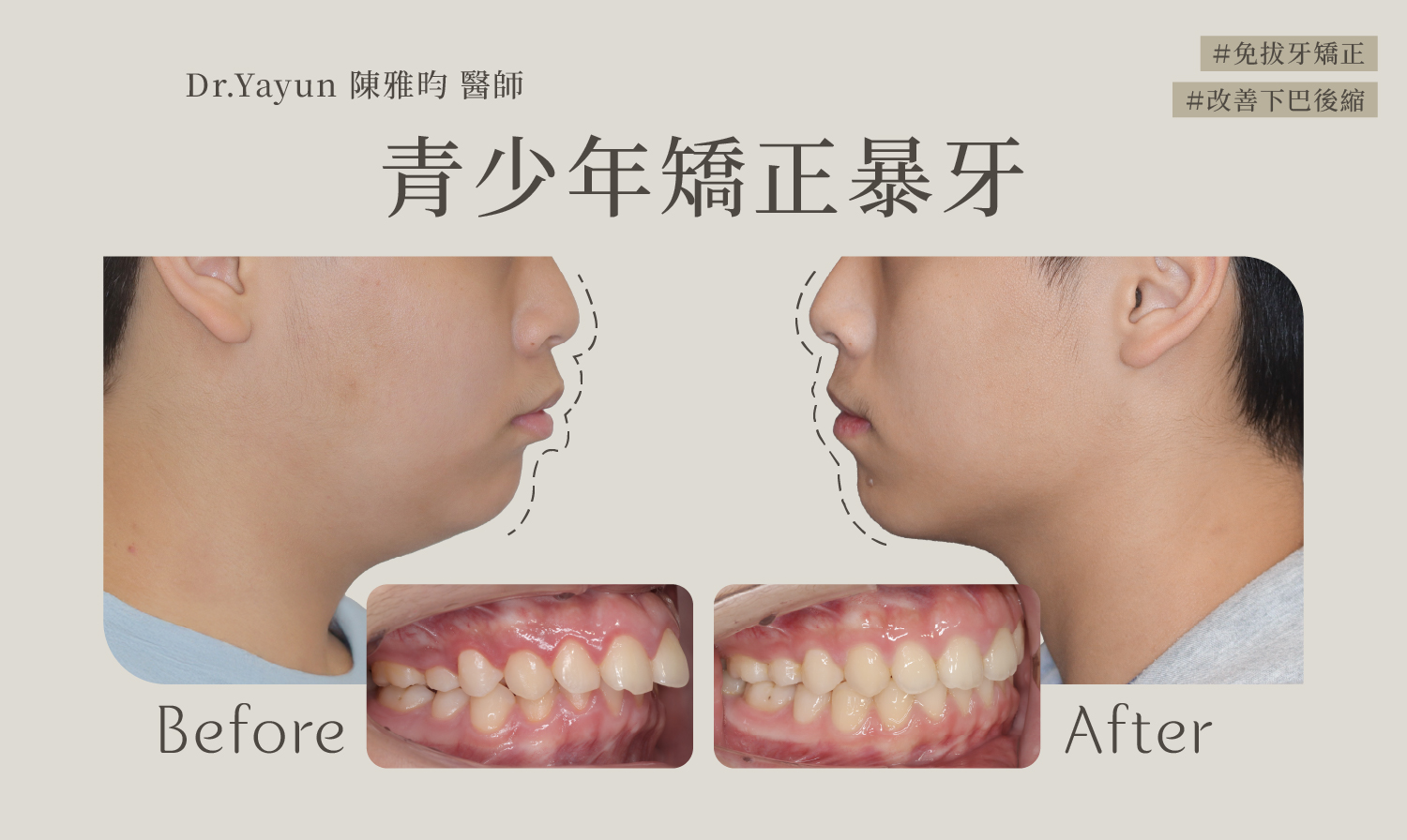 青少年矯正暴牙免拔牙矯正改善下巴後縮牙齒側面對比圖