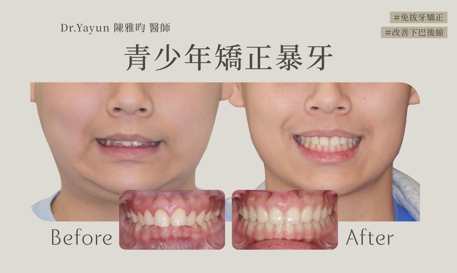 青少年矯正暴牙免拔牙矯正改善下巴後縮牙齒正面對比圖