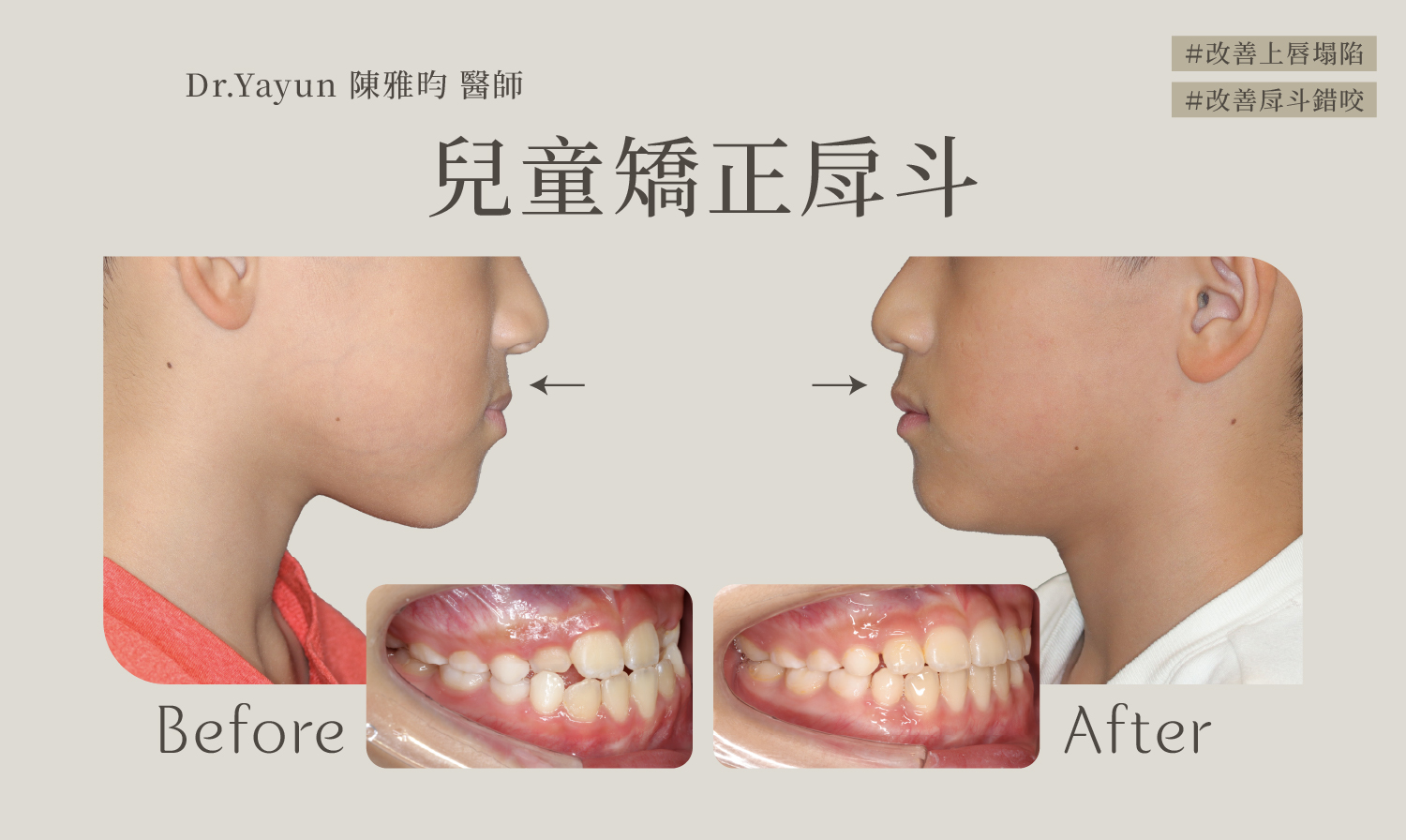 國小男孩改善了戽斗臉型、改善上唇塌陷的側面牙齒前後對比圖
