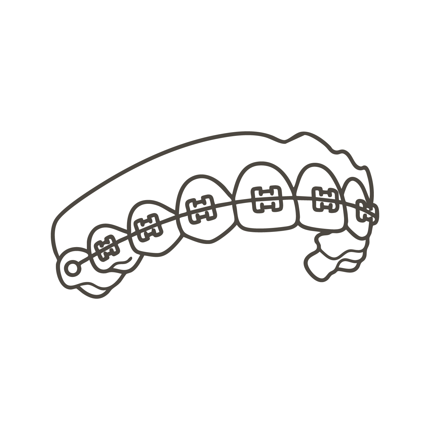 傳統金屬矯正器圖示