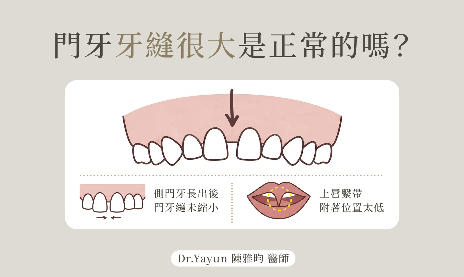 門牙牙縫很大是正常的嗎？